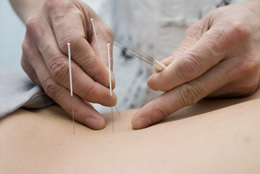 Mit Akupunktur abnehmen – ist das möglich? Wir als Heilpraktiker sind spezialisiert auf Akupunktur im Großraum Hamburg.